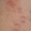 54. Molluscum Contagiosum Early Stages Pictures