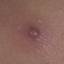 61. Molluscum Contagiosum Early Stages Pictures