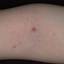 64. Molluscum Contagiosum Early Stages Pictures