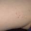 70. Molluscum Contagiosum Early Stages Pictures