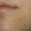 76. Molluscum Contagiosum Early Stages Pictures