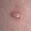80. Molluscum Contagiosum Early Stages Pictures