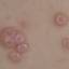 84. Molluscum Contagiosum Early Stages Pictures