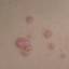 85. Molluscum Contagiosum Early Stages Pictures