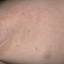 87. Molluscum Contagiosum Early Stages Pictures