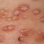 89. Molluscum Contagiosum Early Stages Pictures