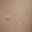 91. Molluscum Contagiosum Early Stages Pictures
