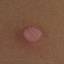 94. Molluscum Contagiosum Early Stages Pictures