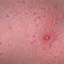 97. Molluscum Contagiosum Early Stages Pictures