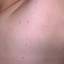 98. Molluscum Contagiosum Early Stages Pictures