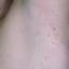 99. Molluscum Contagiosum Early Stages Pictures