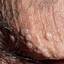 10. Bowenoid Papulosis in Men Pictures
