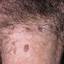 5. Bowenoid Papulosis in Men Pictures