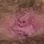 2. Bowenoid Papulosis in Women Pictures