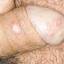 17. Genital Herpes in Men Pictures