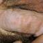 19. Genital Herpes in Men Pictures