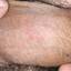 23. Genital Herpes in Men Pictures
