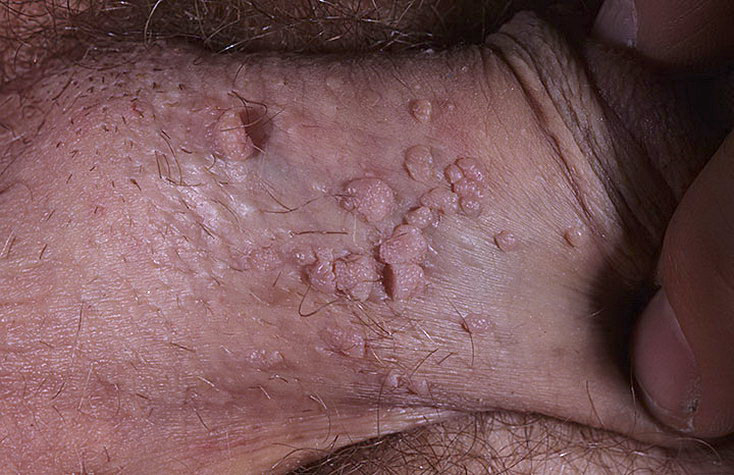 Any of the following symptoms of a genital herpes simplex virus infection c...