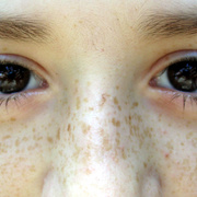 Freckles
