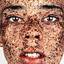 26. Freckles on Face Pictures