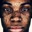 32. Freckles on Face Pictures