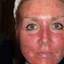 2. Sunburns on Face Pictures