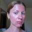 3. Sunburns on Face Pictures