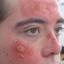 5. Sunburns on Face Pictures