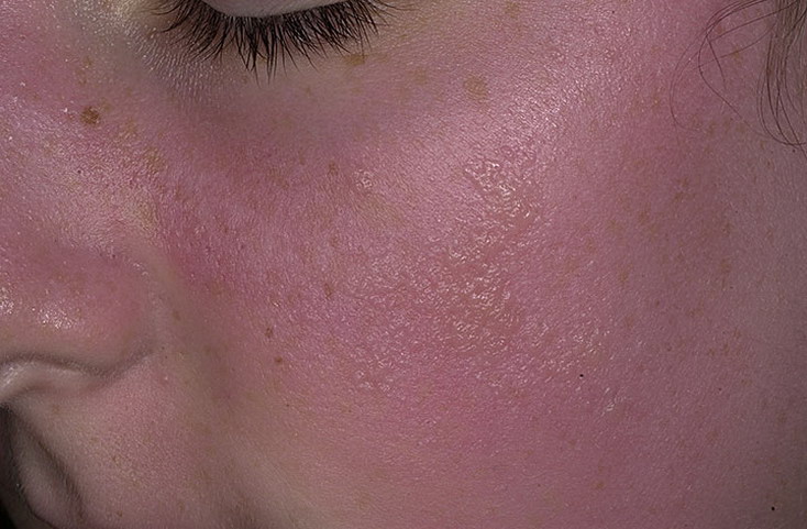 symptoms of sunburned eyeballs