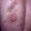 12. The Spots of Neurofibromatosis Pictures