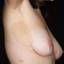13. The Spots of Neurofibromatosis Pictures
