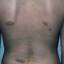 14. The Spots of Neurofibromatosis Pictures