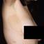 12. Neurofibromatosis Early Stages Pictures