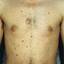 14. Adults with Neurofibromatosis Pictures