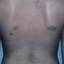 19. Adults with Neurofibromatosis Pictures