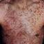 3. Adults with Neurofibromatosis Pictures