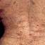 32. Adults with Neurofibromatosis Pictures