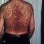 4. Adults with Neurofibromatosis Pictures