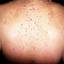 40. Adults with Neurofibromatosis Pictures
