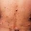 41. Adults with Neurofibromatosis Pictures