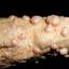 44. Adults with Neurofibromatosis Pictures