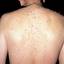 46. Adults with Neurofibromatosis Pictures