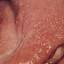 58. Adults with Neurofibromatosis Pictures