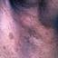 61. Adults with Neurofibromatosis Pictures