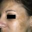 1. Chloasma on Face Pictures