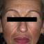 11. Chloasma on Face Pictures
