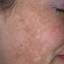 17. Chloasma on Face Pictures