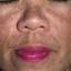 20. Chloasma on Face Pictures