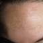 22. Chloasma on Face Pictures