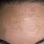 3. Chloasma on Face Pictures